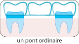 Couronne et bridge dentaire en Hongrie