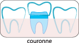 Couronne dentaire en Hongrie